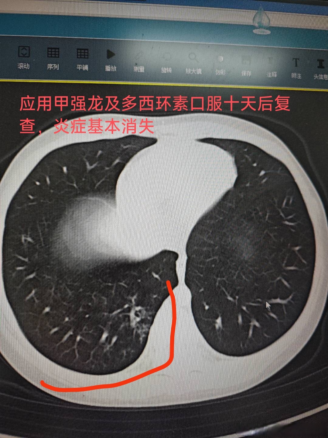 “新疆肺炎” 新疆 肺炎？-第2张图片